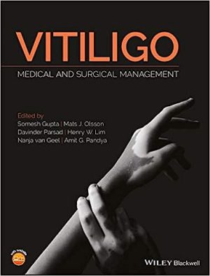 Vitiligo Medical and Surgical Management