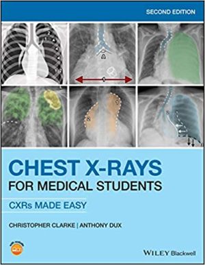Chest XRays for Medical Students CXRs Made Easy 2nd Edition