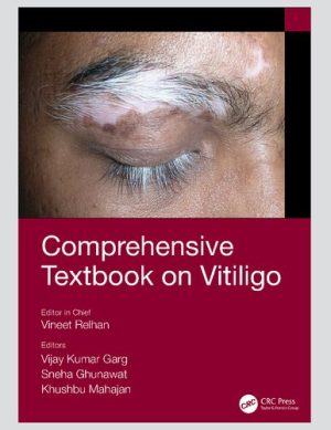 Comprehensive Textbook on Vitiligo